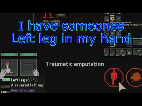 Barotrauma – The man and his missing left leg